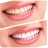 Advanced 2 Person Home Whitening System and Free Remineralization Gel